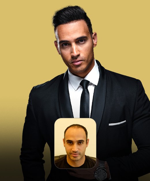Best Hair Transplant Near me_01