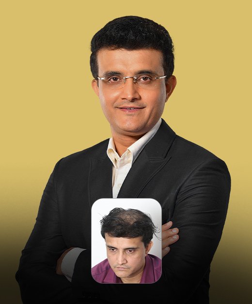 Best Hair Transplant Near me_03