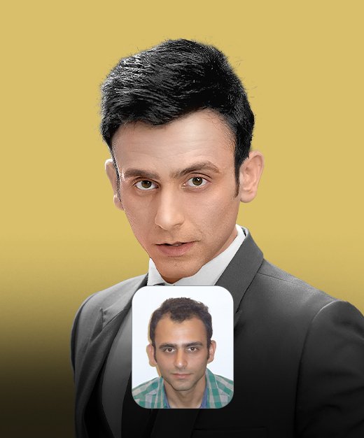 Best Hair Transplant Near me_05